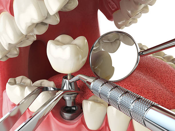 Best Emergency Wisdom Tooth Extraction in West Terre Haute, IN
